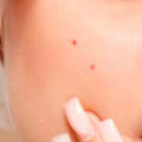 ACNE & BREAKOUTS
