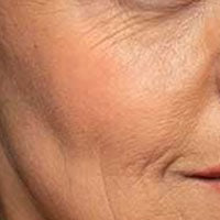Dark Circles