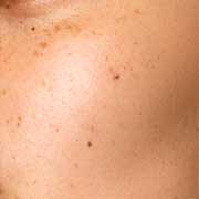 Dark Circles